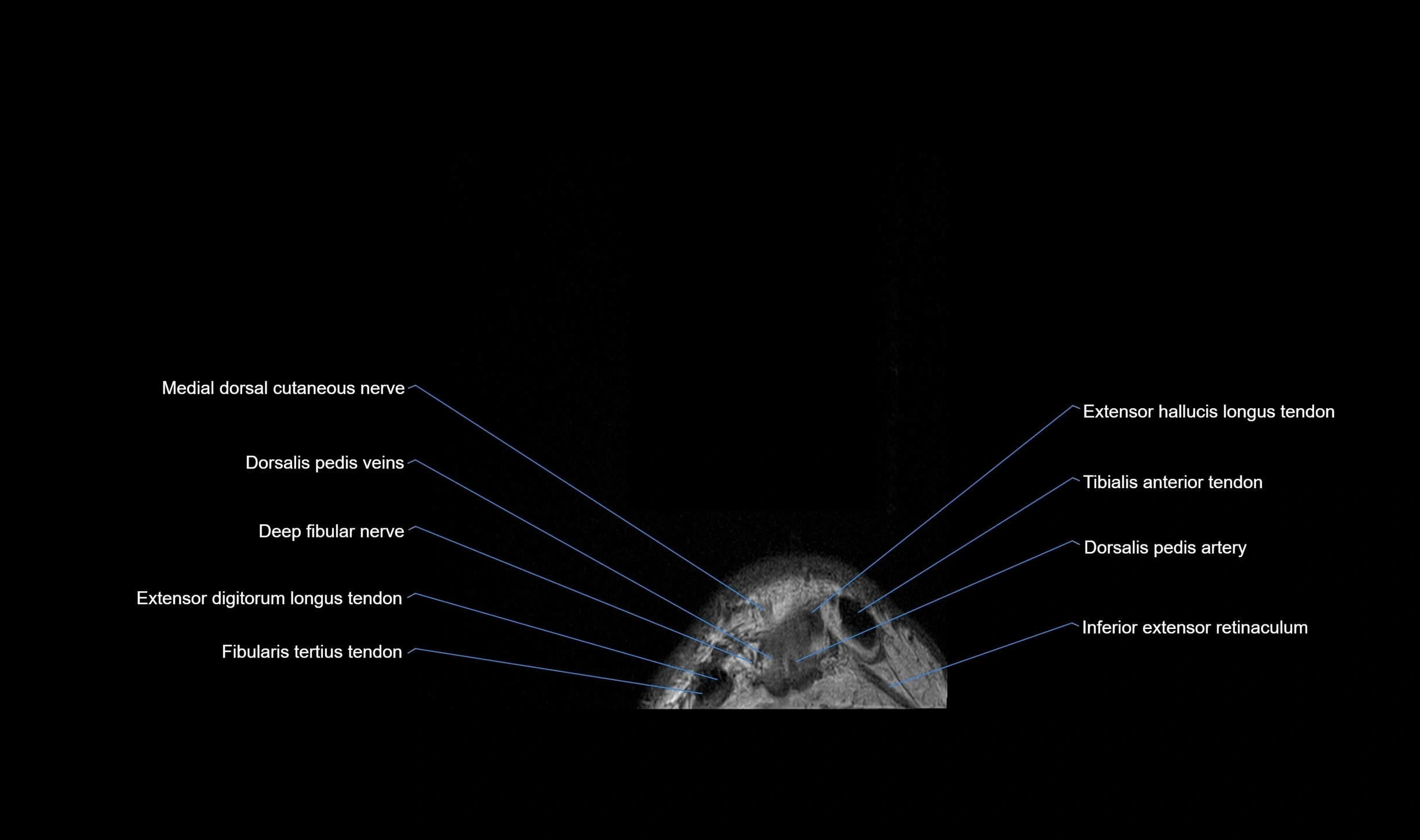 MRI mid foot coronal ligaments cross sectional anatomy 3T  radiology  image-img-00001-00003.webp
